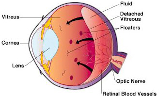 floaters flashes New Jersey eye doctor