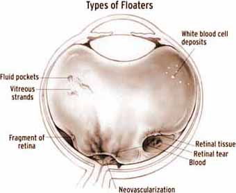 floaters mesa New Jersey eye doctor