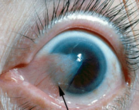 pterygium colorado