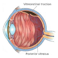 vitreous detachment New Jersey eye doctor